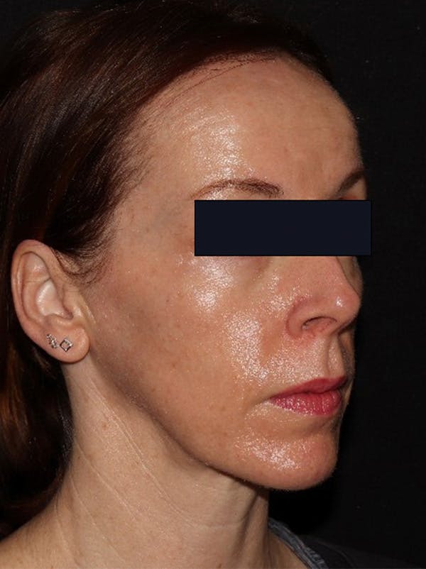 Microneedling Before & After Gallery - Patient 146131272 - Image 6