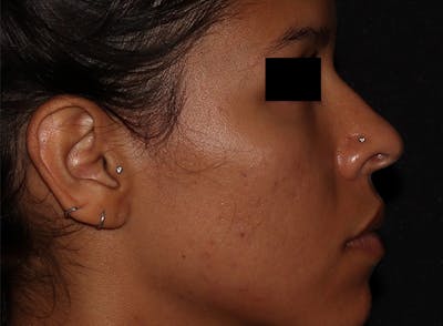 Microneedling Before & After Gallery - Patient 146131274 - Image 1