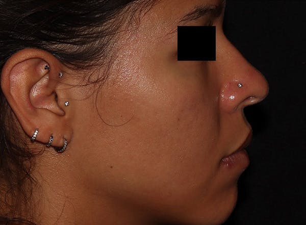 Microneedling Before & After Gallery - Patient 146131274 - Image 2