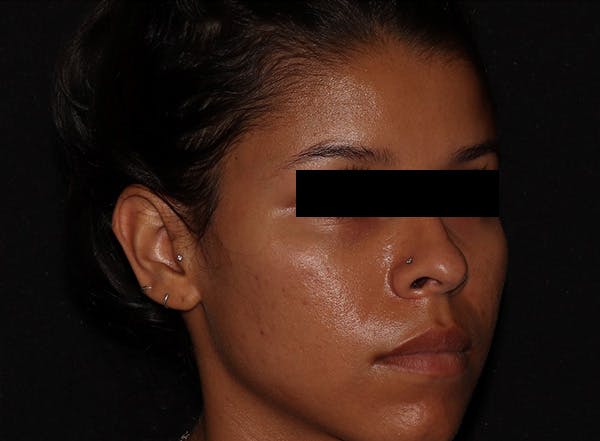 Microneedling Before & After Gallery - Patient 146131274 - Image 3