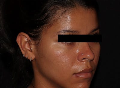 Microneedling Before & After Gallery - Patient 146131274 - Image 4
