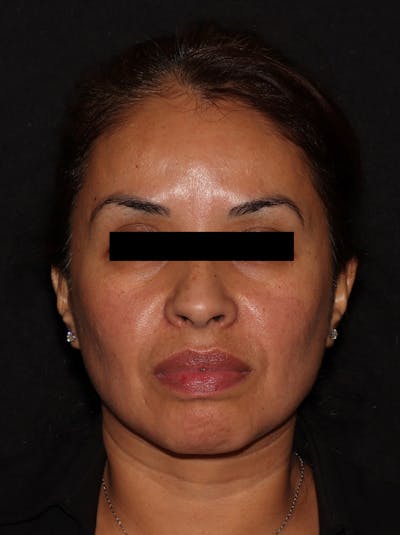 Chemical Peel Before & After Gallery - Patient 146131279 - Image 1