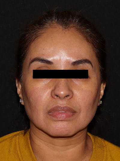 Chemical Peel Before & After Gallery - Patient 146131279 - Image 2