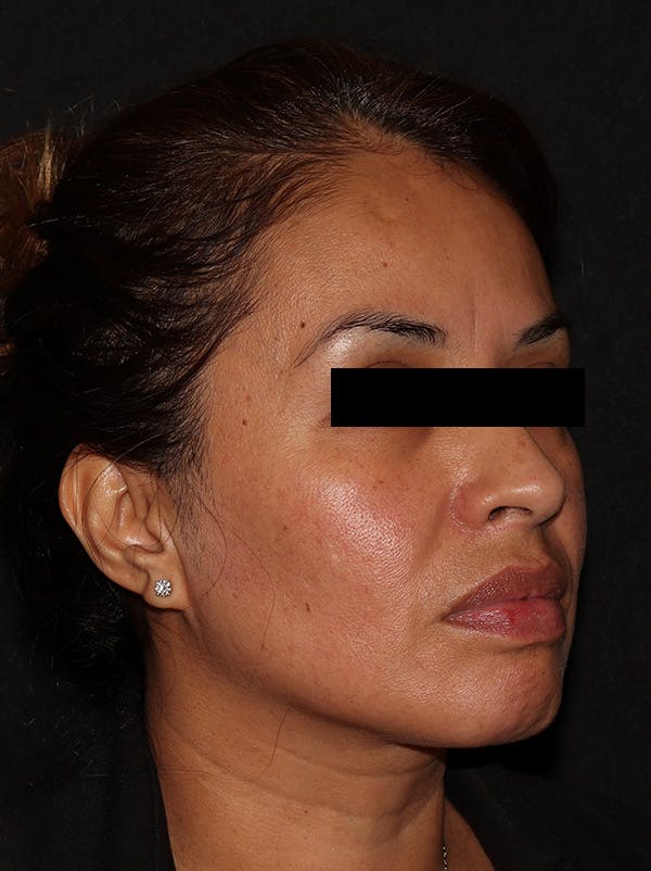 Chemical Peel Before & After Gallery - Patient 146131279 - Image 3