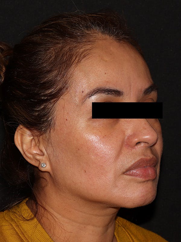 Chemical Peel Before & After Gallery - Patient 146131279 - Image 4