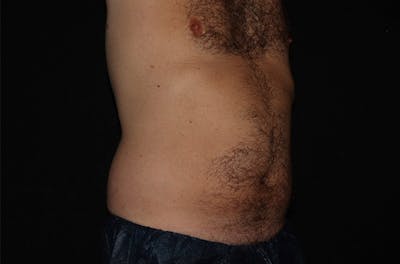 CoolSculpting® Elite Before & After Gallery - Patient 146131284 - Image 1