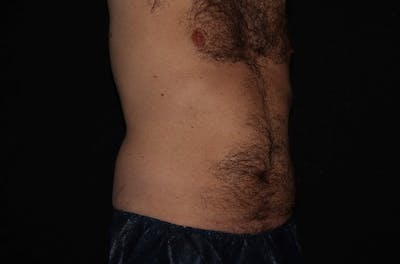 CoolSculpting® Elite Before & After Gallery - Patient 146131284 - Image 2