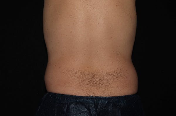 CoolSculpting® Elite Before & After Gallery - Patient 146131284 - Image 3