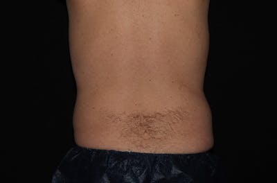 CoolSculpting® Elite Before & After Gallery - Patient 146131284 - Image 4