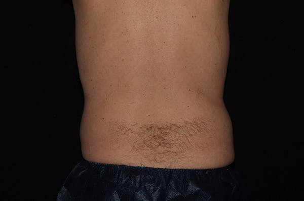 CoolSculpting® Elite Before & After Gallery - Patient 146131284 - Image 4