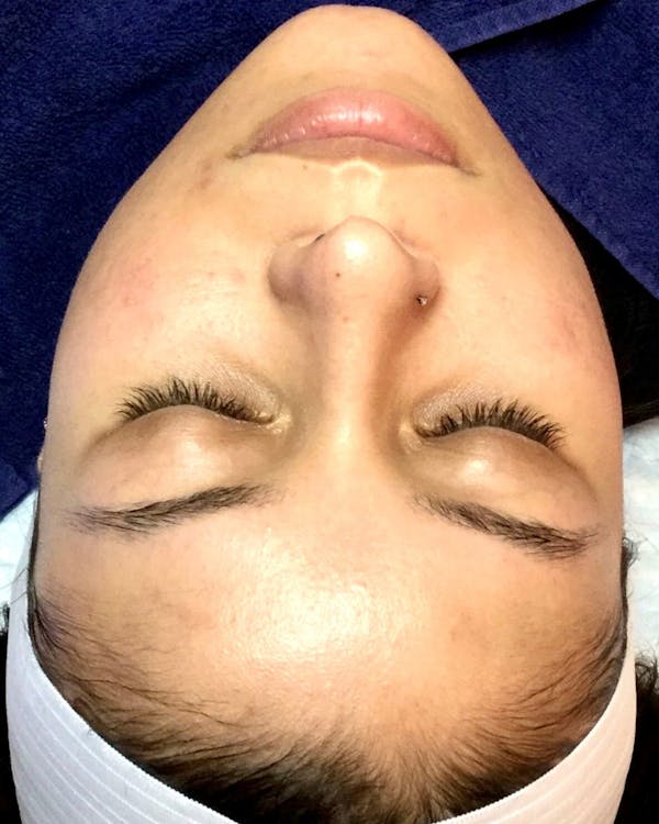 Hydrafacial Before & After Gallery - Patient 146131301 - Image 1