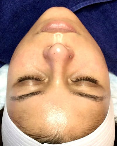 Hydrafacial Before & After Gallery - Patient 146131301 - Image 2
