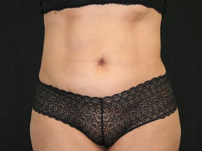 Female Liposuction Before & After Gallery - Patient 146131312 - Image 2