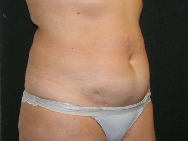 Female Liposuction Before & After Gallery - Patient 146131312 - Image 3