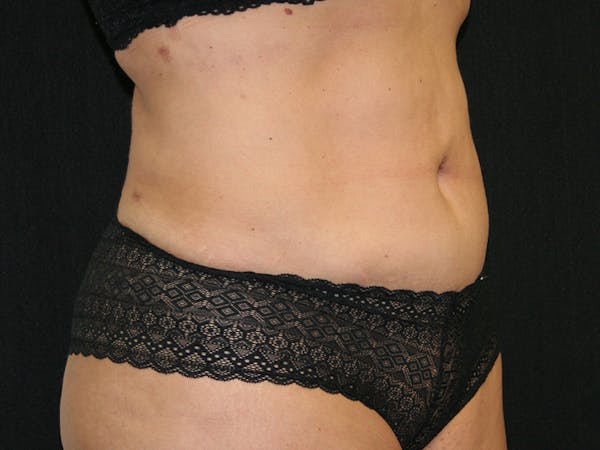 Female Liposuction Before & After Gallery - Patient 146131312 - Image 4