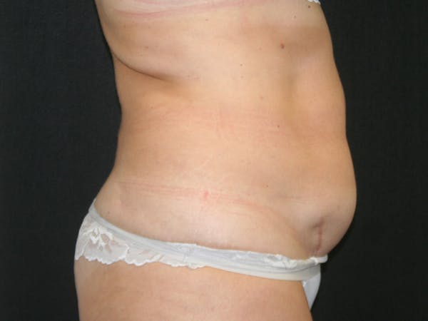 Female Liposuction Before & After Gallery - Patient 146131312 - Image 5