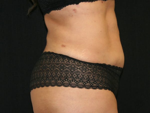 Female Liposuction Before & After Gallery - Patient 146131312 - Image 6