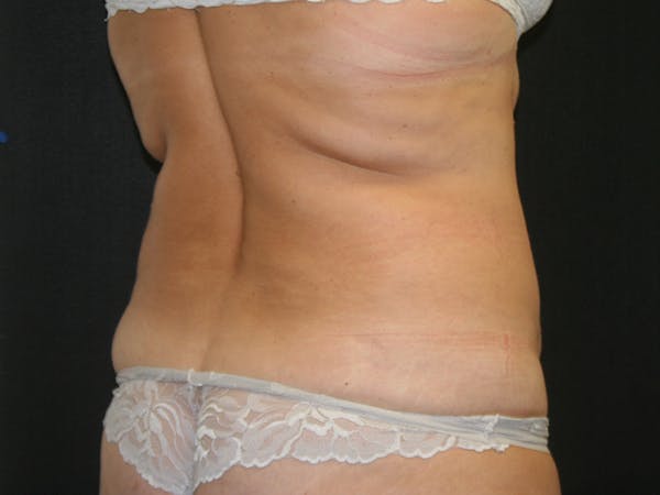 Female Liposuction Before & After Gallery - Patient 146131312 - Image 7