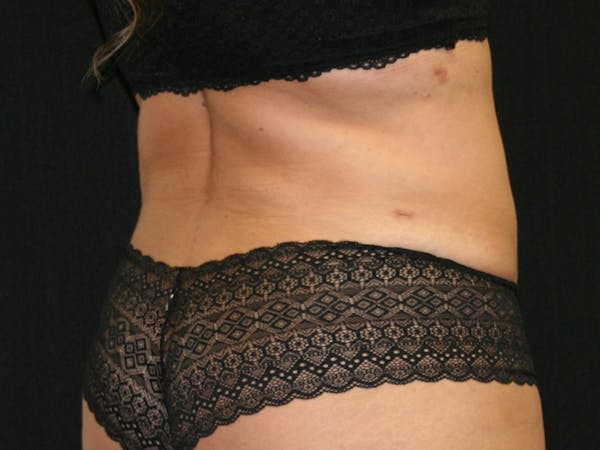 Female Liposuction Before & After Gallery - Patient 146131312 - Image 8