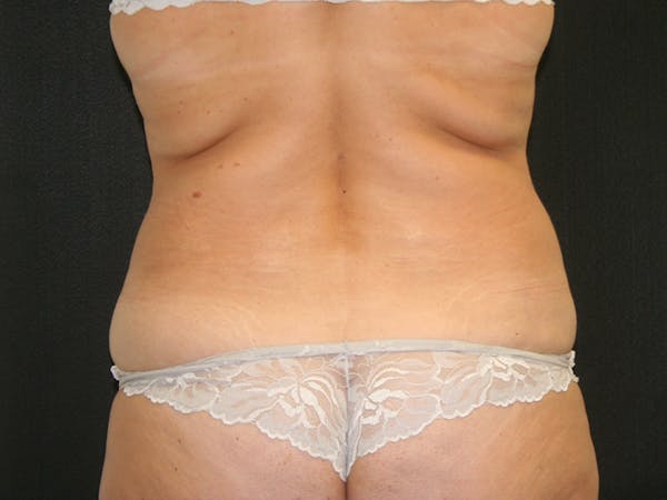 Female Liposuction Before & After Gallery - Patient 146131312 - Image 9