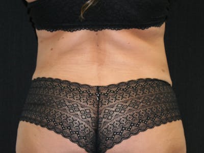 Female Liposuction Before & After Gallery - Patient 146131312 - Image 10