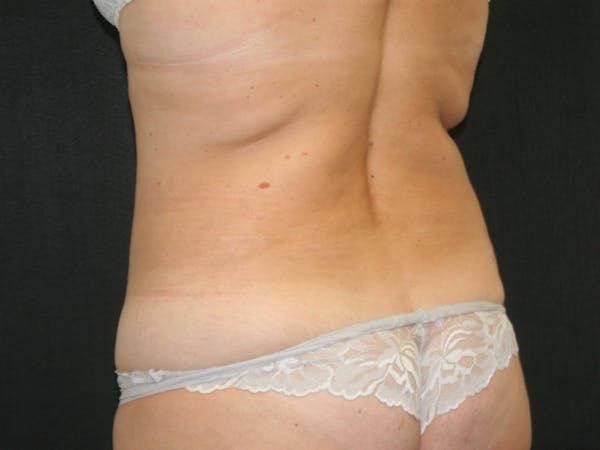 Female Liposuction Before & After Gallery - Patient 146131312 - Image 11