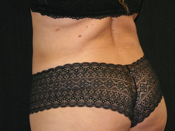Female Liposuction Before & After Gallery - Patient 146131312 - Image 12