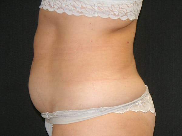 Female Liposuction Before & After Gallery - Patient 146131312 - Image 13
