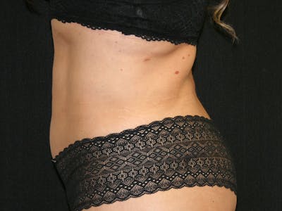 Female Liposuction Before & After Gallery - Patient 146131312 - Image 14
