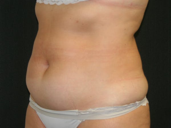 Female Liposuction Before & After Gallery - Patient 146131312 - Image 15