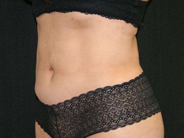 Female Liposuction Before & After Gallery - Patient 146131312 - Image 16