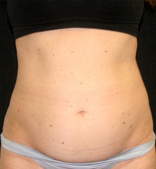 Tummy Tuck Before & After Gallery - Patient 146131309 - Image 1