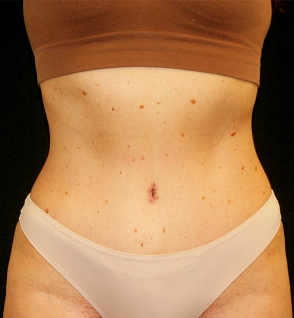 Tummy Tuck Before & After Gallery - Patient 146131309 - Image 2