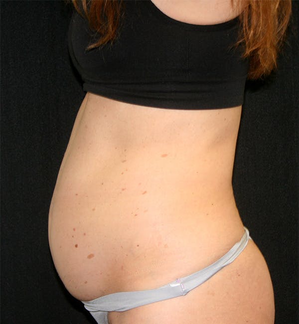 Tummy Tuck Before & After Gallery - Patient 146131309 - Image 3