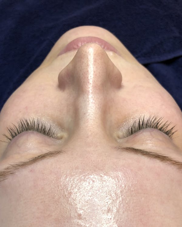 Hydrafacial Before & After Gallery - Patient 146131304 - Image 1