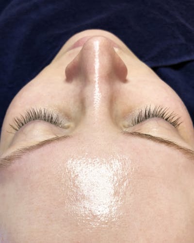 Hydrafacial Before & After Gallery - Patient 146131304 - Image 2