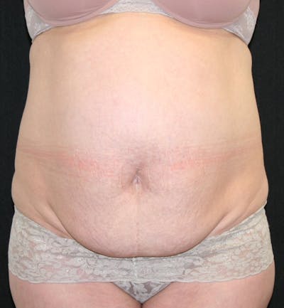 Tummy Tuck Before & After Gallery - Patient 146194191 - Image 1