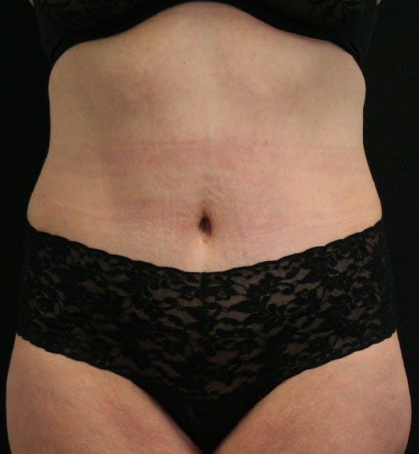 Tummy Tuck Before & After Gallery - Patient 146194191 - Image 2