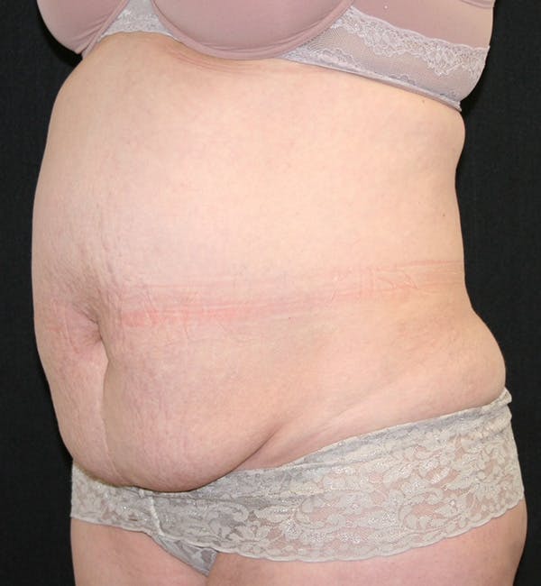 Tummy Tuck Before & After Gallery - Patient 146194191 - Image 3