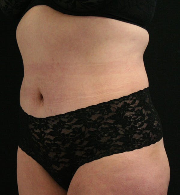 Tummy Tuck Before & After Gallery - Patient 146194191 - Image 4