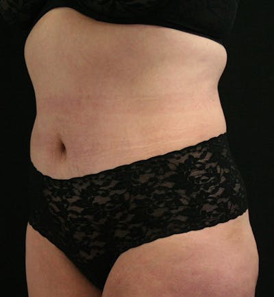 Tummy Tuck Before & After Gallery - Patient 146194191 - Image 4