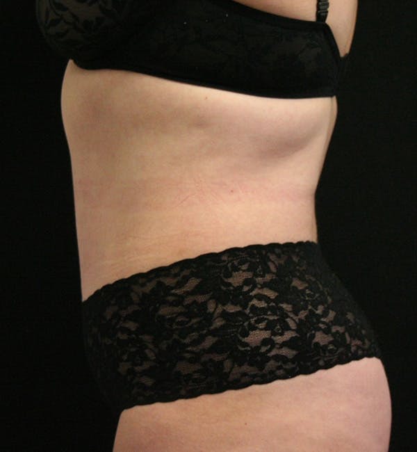 Tummy Tuck Before & After Gallery - Patient 146194191 - Image 6