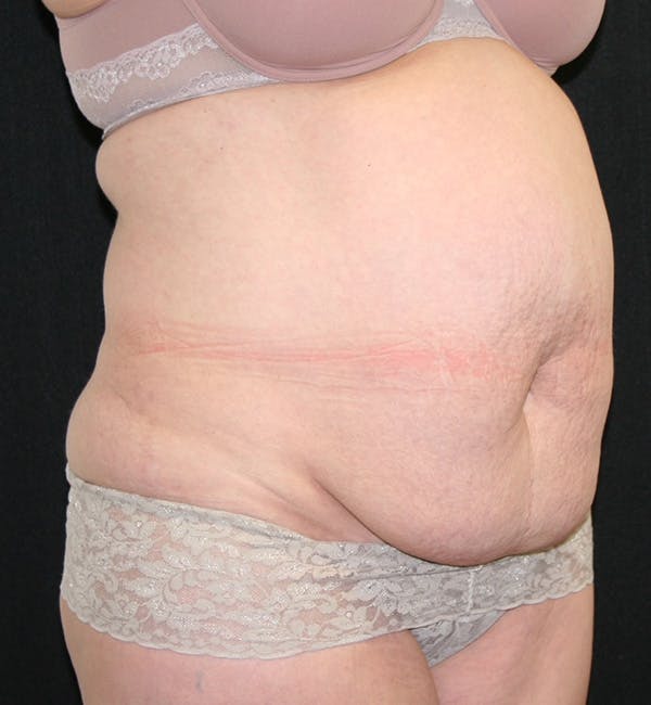 Tummy Tuck Before & After Gallery - Patient 146194191 - Image 7