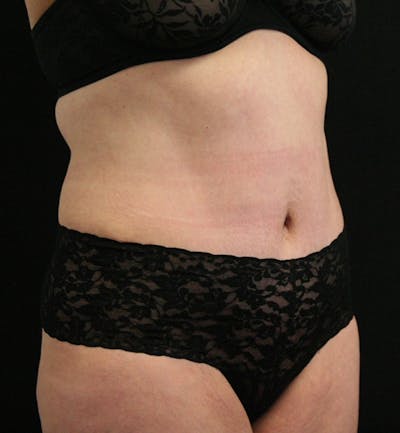 Tummy Tuck Before & After Gallery - Patient 146194191 - Image 8