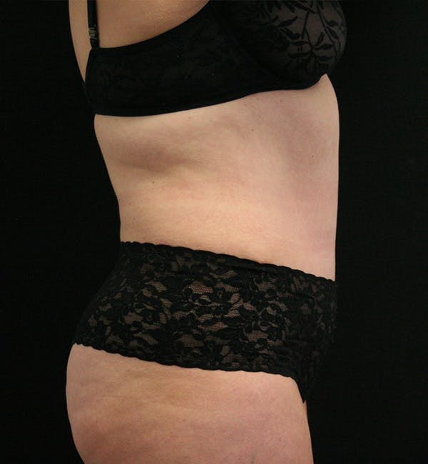 Tummy Tuck Before & After Gallery - Patient 146194191 - Image 10