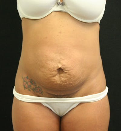 Tummy Tuck Before & After Gallery - Patient 146247228 - Image 1