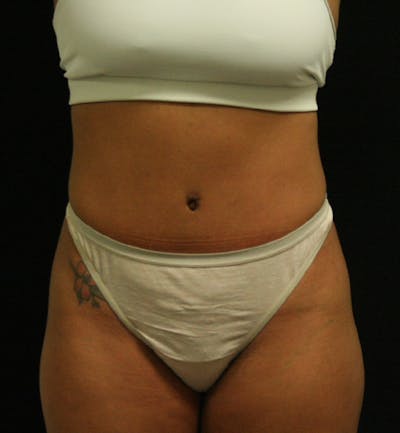 Tummy Tuck Before & After Gallery - Patient 146247228 - Image 2
