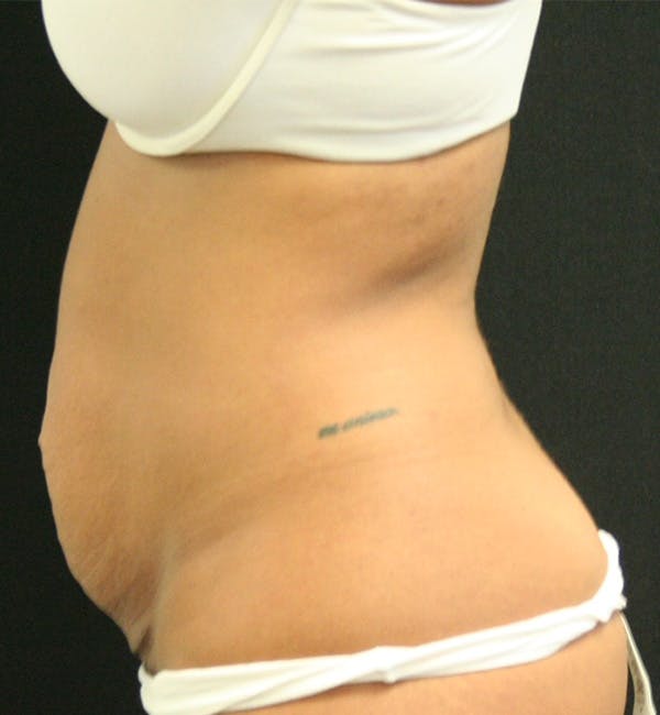 Tummy Tuck Before & After Gallery - Patient 146247228 - Image 5