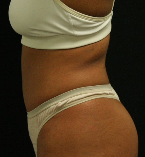 Tummy Tuck Before & After Gallery - Patient 146247228 - Image 6