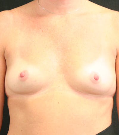 Breast Augmentation Before & After Gallery - Patient 146247823 - Image 1